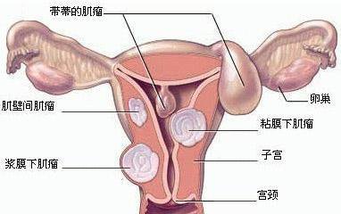 子宫肌瘤引起心脏不适