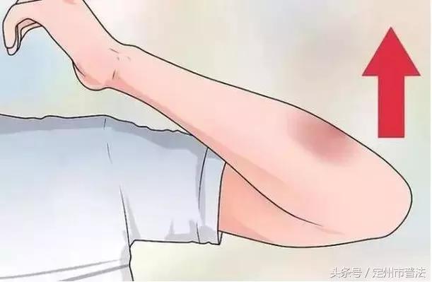 为什么女生身上会出现淤青